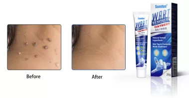 How To Use Jaysuing Wart Remover: A Comprehensive Guide