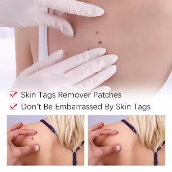 Jaysuing Skin Tag Remover and Repair Set Jaysuing Skin Tag Remover and Repair Set