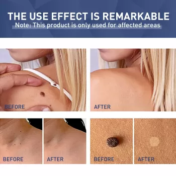 Jaysuing Wart Remover Liquid Skin Tag Removal Jaysuing Wart Remover Liquid Skin Tag Removal