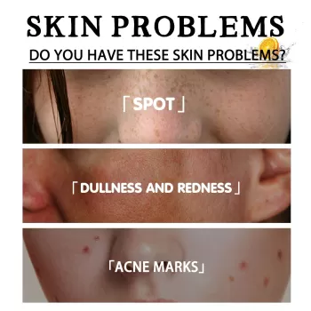 Jaysuing Freckle Removal Face Serum Jaysuing Freckle Removal Face Serum