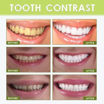 Teeth Whitening Stickers Cocoanut Oil Teeth Whitening Stickers Cocoanut Oil