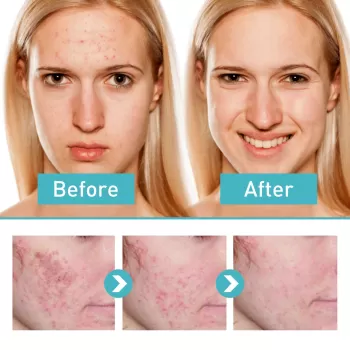 Jaysuing 7 Days Acne Control Gel - 20ml Jaysuing 7 Days Acne Control Gel - 20ml