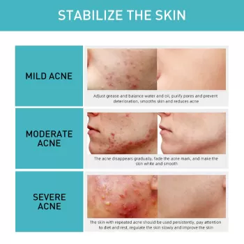 Jaysuing 7 Days Acne Control Gel - 20ml Jaysuing 7 Days Acne Control Gel - 20ml