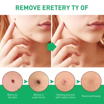 Jaysuing Wart Corns Remover Gel Jaysuing Wart Corns Remover Gel