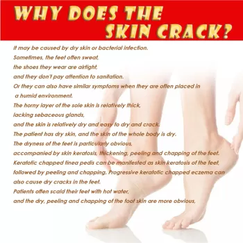 Jaysuing Foot Crack Cream Banana Moisturizing Jaysuing Foot Crack Cream Banana Moisturizing