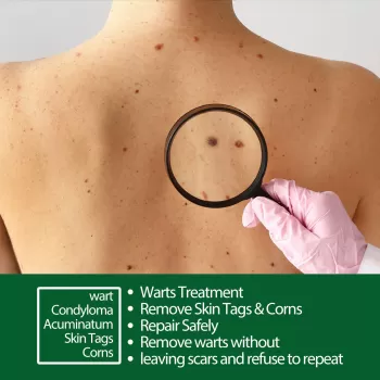 Jaysuing Wart Remover Liquid Painless Treatment Meat Corn Skin Flat Wart Jaysuing Wart Remover Liquid Painless Treatment Meat Corn Skin Flat Wart