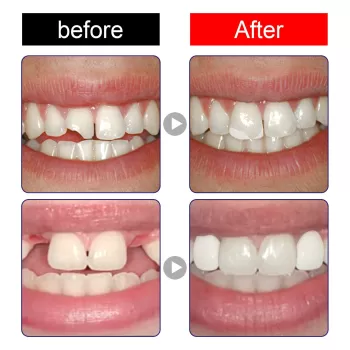Jaysuing Moldable False Teeth Jaysuing Moldable False Teeth