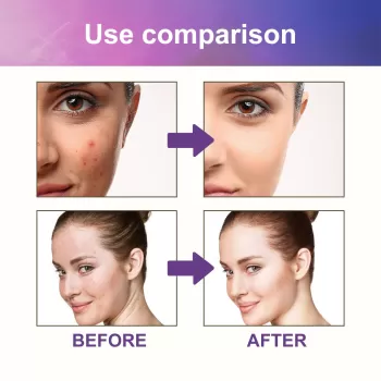 Jaysuing Acne Pimple Patch Anti Acne Waterproof Jaysuing Acne Pimple Patch Anti Acne Waterproof