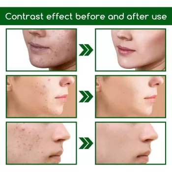 Jaysuing Acne Treatment Face Serum Jaysuing Acne Treatment Face Serum