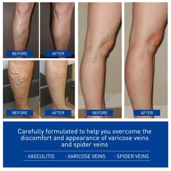 Jaysuing Varicose Vein Cream Jaysuing Varicose Vein Cream