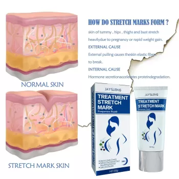 Jaysuing Stretch Mark Removal Cream Jaysuing Stretch Mark Removal Cream