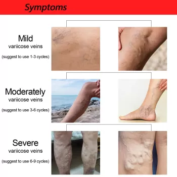 Jaysuing Varicose Vein Relief Patch Jaysuing Varicose Vein Relief Patch