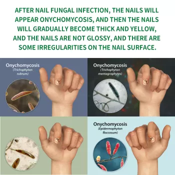 Jaysuing Nail Fungus Treatment Essence Serum Jaysuing Nail Fungus Treatment Essence Serum