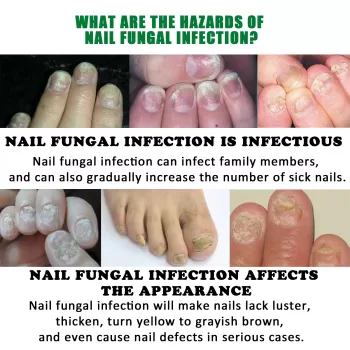 Jaysuing Nail Fungus Treatment Essence Serum Jaysuing Nail Fungus Treatment Essence Serum